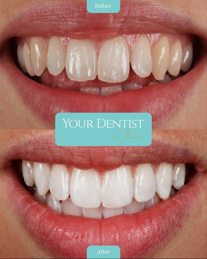 Professional teeth whitening in Thame, Oxfordshire